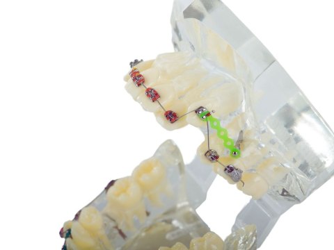 Model stomatologiczny szczęka zęby zębów aparat ortodontyczny Model stomatologiczny szczęka zęby zębów aparat ortodontyczny