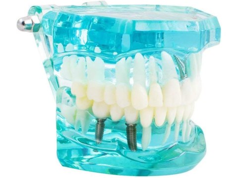 Model stomatologiczny szczęka zęby zębow implanty Model stomatologiczny szczęka zęby zębow implanty