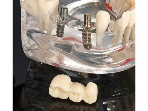 Model stomatologiczny szczęka zęby zębow implanty Model stomatologiczny szczęka zęby zębow implanty